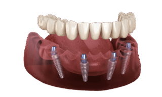 All-on-four-fixed-Zirconia https://lovenewsmiles.com/wp-content/uploads/2025/09/All-on-four-fixed-Zirconia-320x192.png