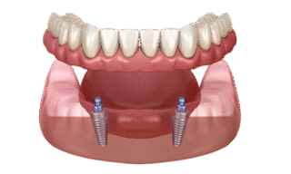 Overdenture https://lovenewsmiles.com/wp-content/uploads/2025/09/Overdenture-320x192.png