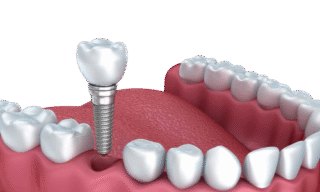 Single-Dental-Implant https://lovenewsmiles.com/wp-content/uploads/2025/09/Single-Dental-Implant-320x192.png